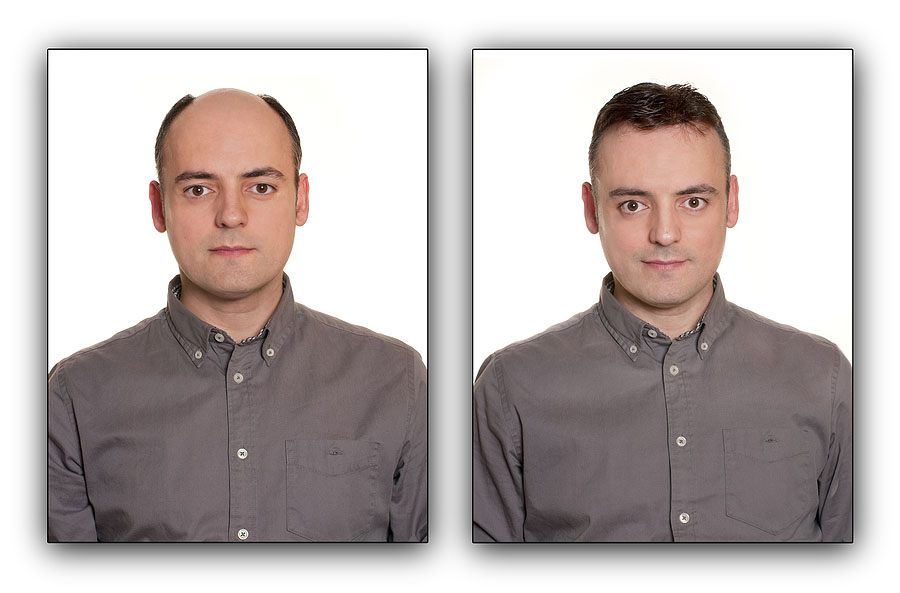 Bald man with a Toupee . Before & After Concept.