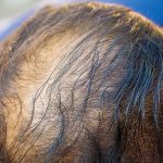 Custom Toupees for Sports Enthusiasts, Close up hair loss, thinning hair and scalp issue. hair loss